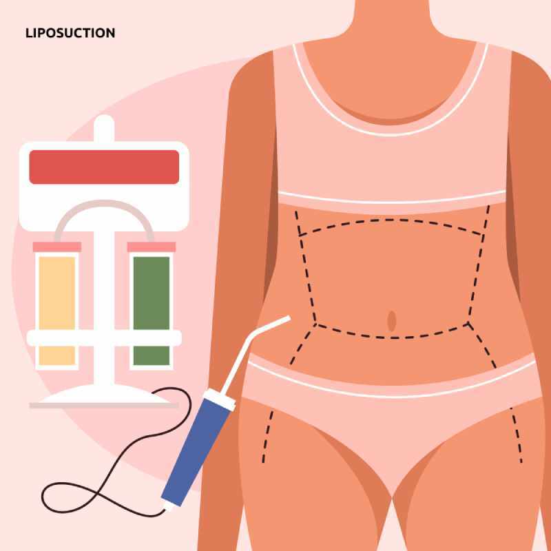 liposuction antalya