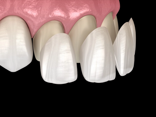 laminate veneers antalya