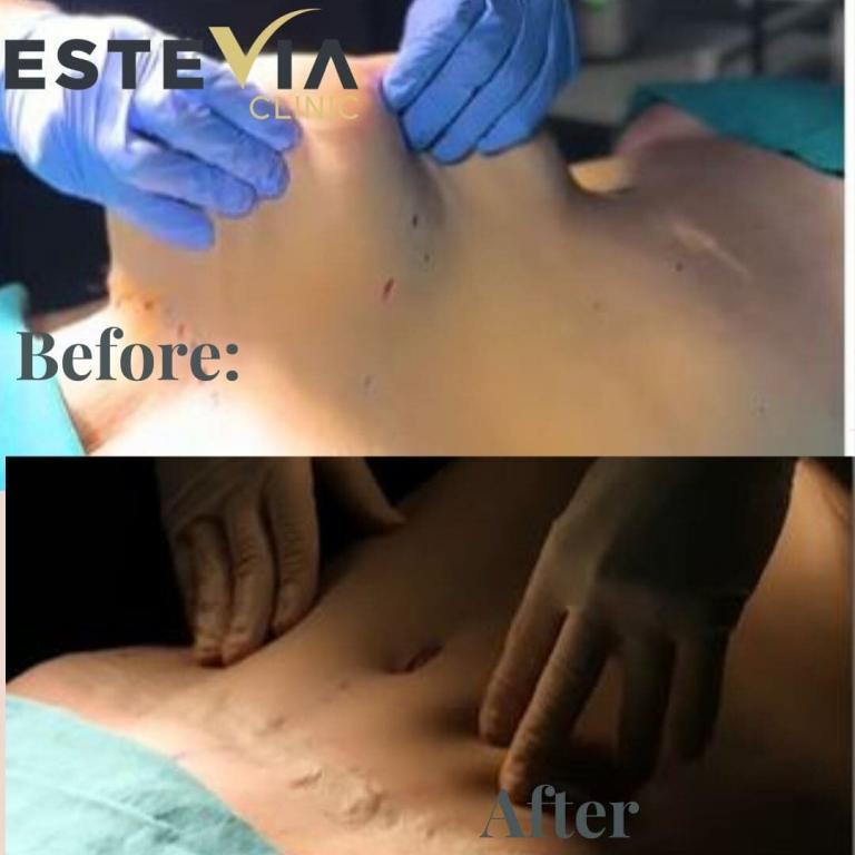 liposuction antalya
