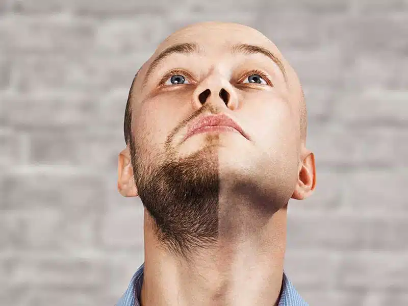 beard transplant coast