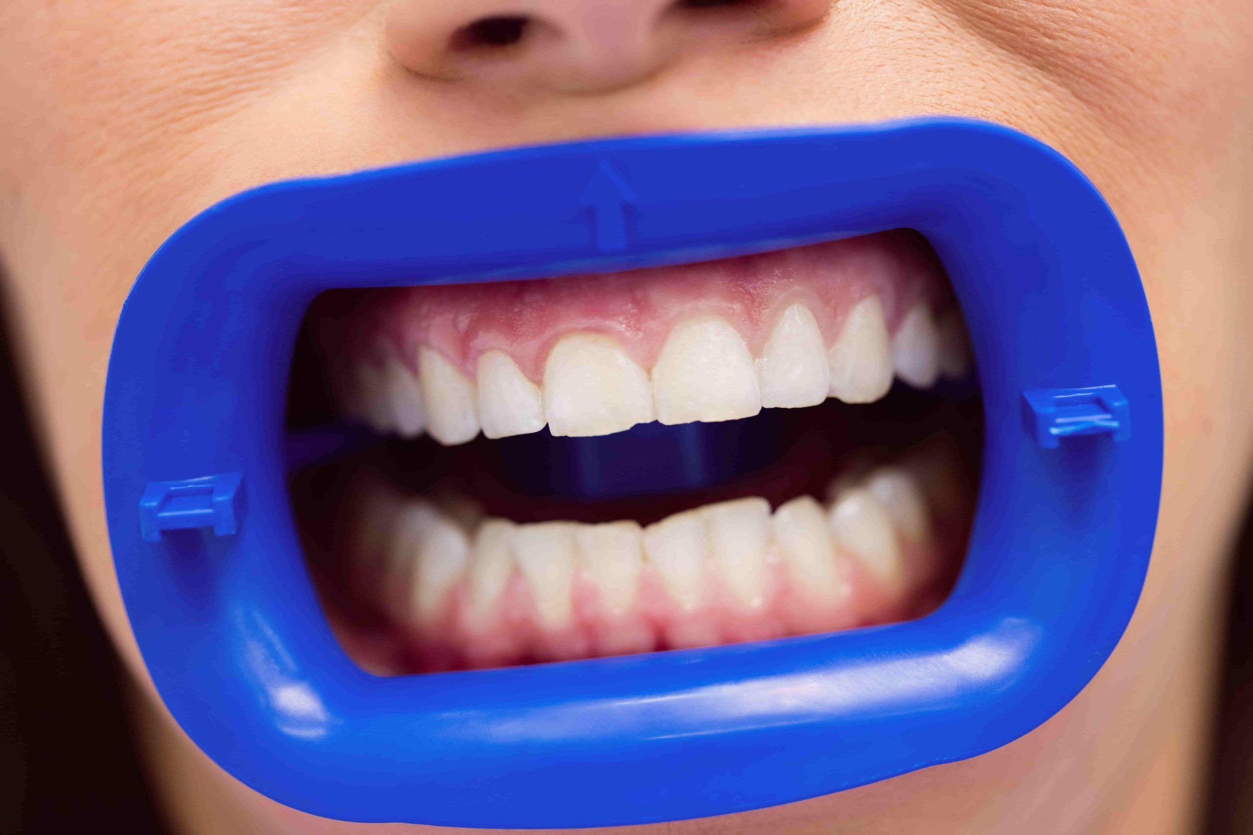 teeth whitening antalya