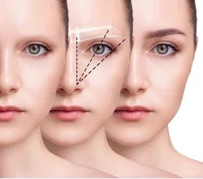 eyebrow antalya transplant