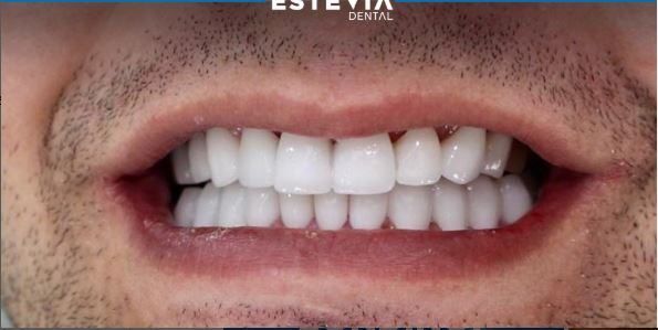 before-after