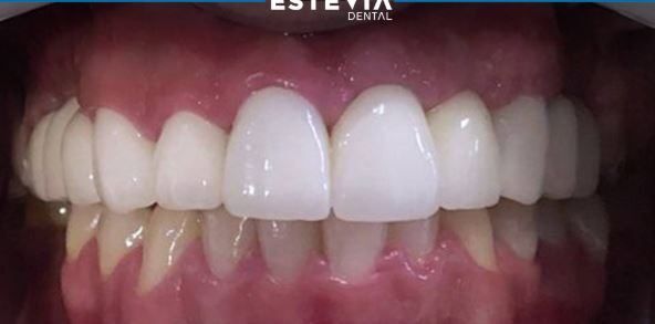 before-after