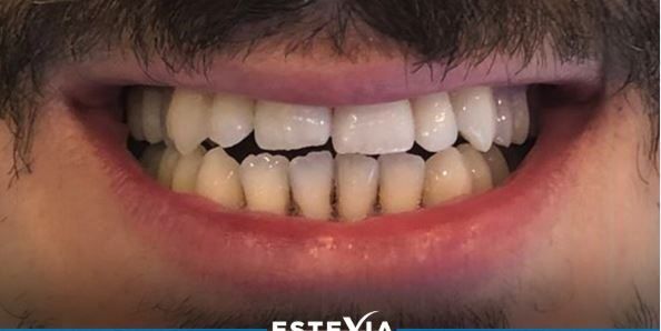before-after