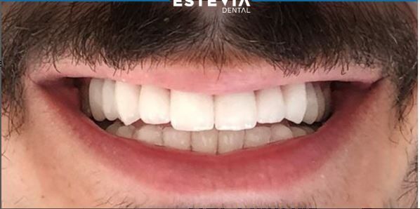 before-after