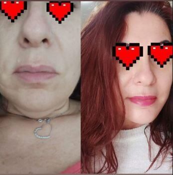 rhytidectomy antalya