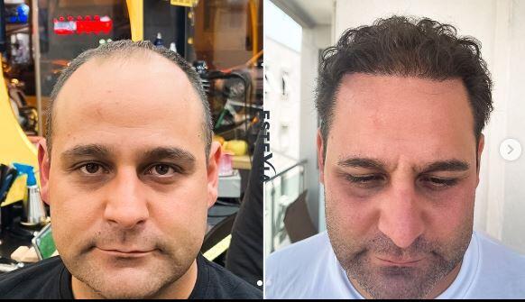 hair trnasplant before after-min
