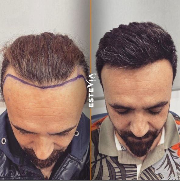 hair turkey before after