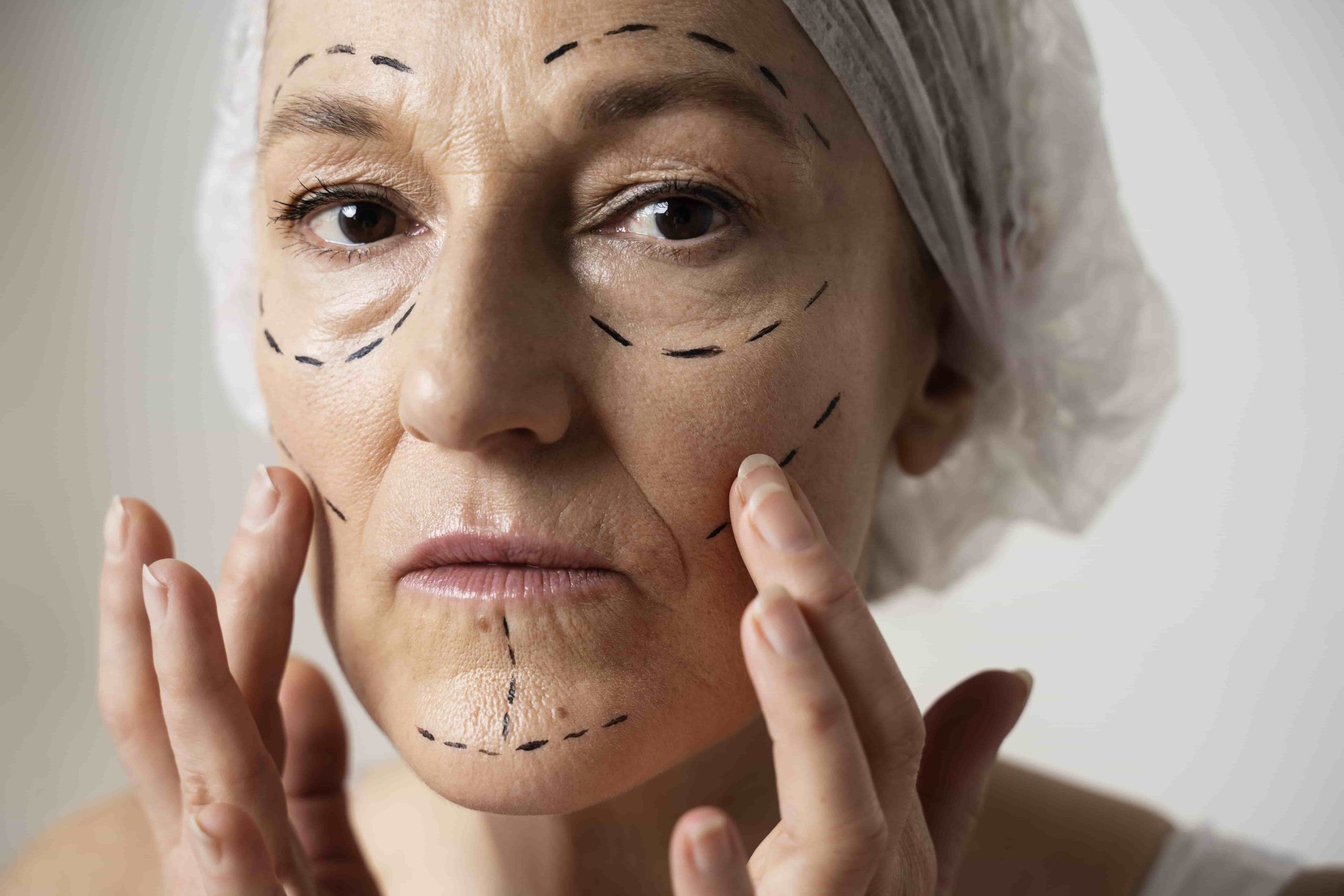 facelift ryhtidectomy