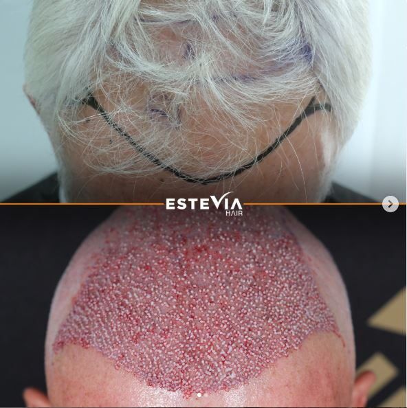 white hair transplant