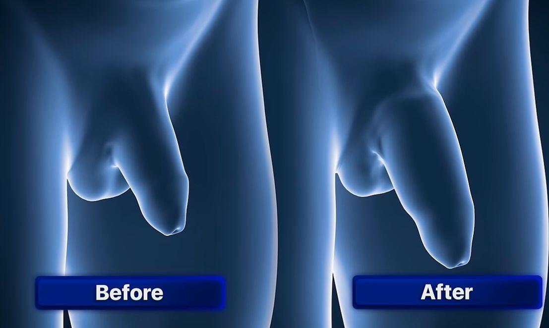 penile enlargement antalya