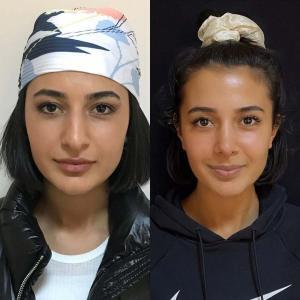 Meilleur chirurgien rhinoplastie Turquie Dr Gokhan Efe EsteVia Clinic