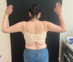 Arm lipo Turkey