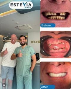 implant four
