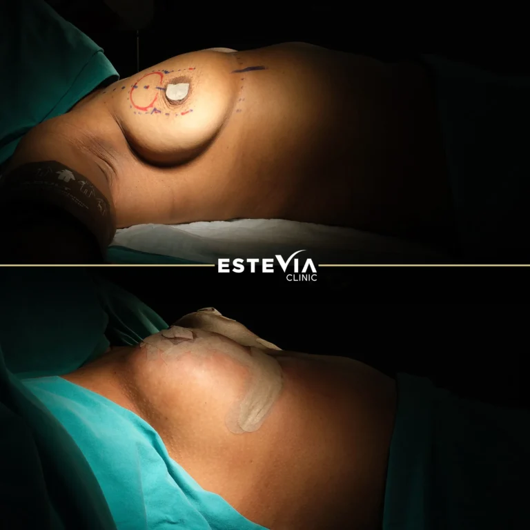 ethnic boobs lift