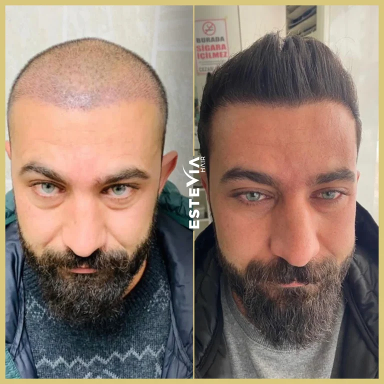 hair-transplant-antalya-estevia-clinic-12