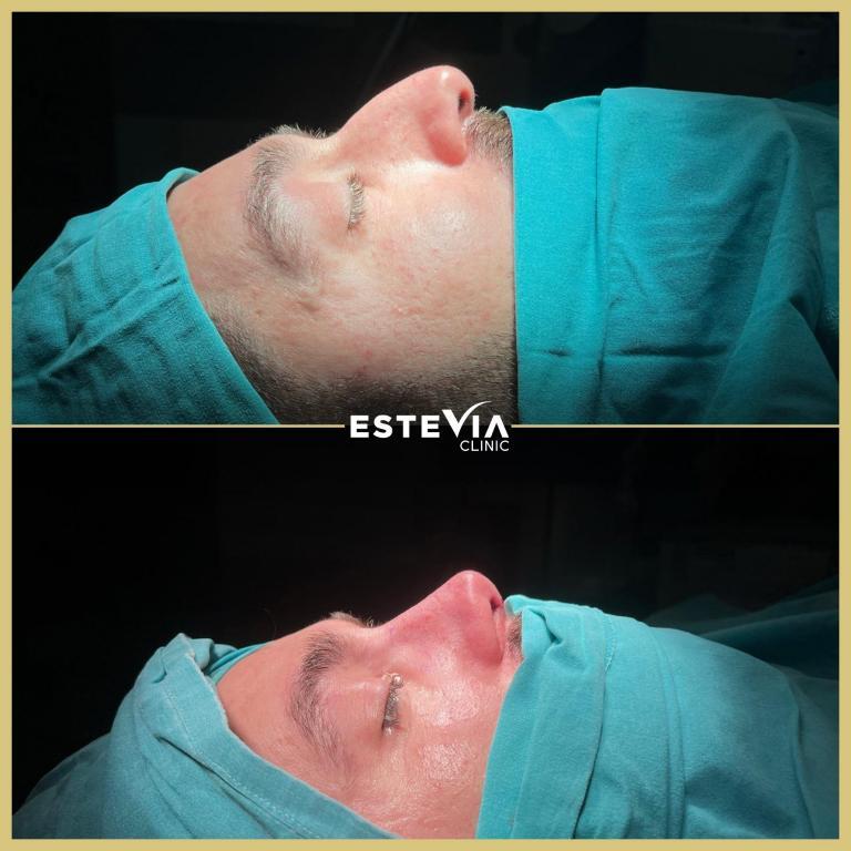 rhinoplasty male antalya