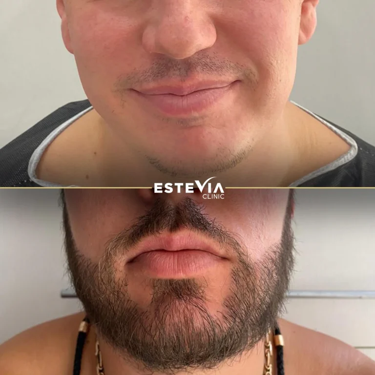 antalya beard transplant