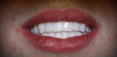 before-after