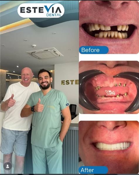 Dental implants turkey price consultation WhatsApp EsteVia Clinic