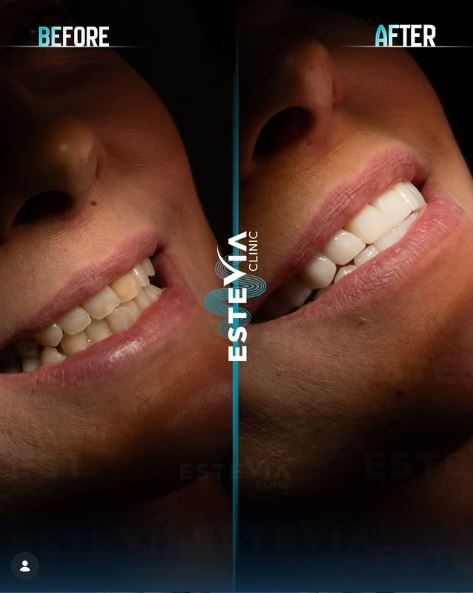 Facette dentaire Turquie avis consultation gratuite WhatsApp EsteVia Clinic