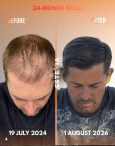 Unshaven hair transplant turkey before and after result EsteVia Clinic