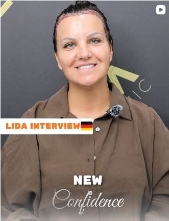 Female hair transplant turkey package 5 star hotel and VIP transfer