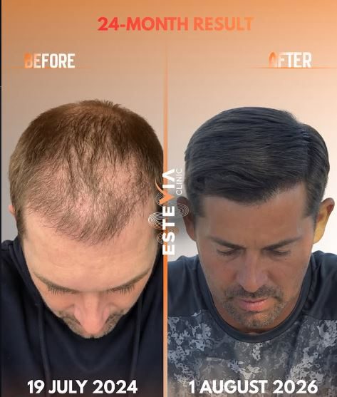 Hair transplant turkey before and after hairline density result EsteVia Clinic