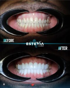 Hollywood smile Turkey before and after veneers result Dt Huseyin Ay