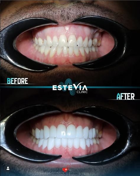 Hollywood smile Turkey before and after veneers result Dt Huseyin Ay