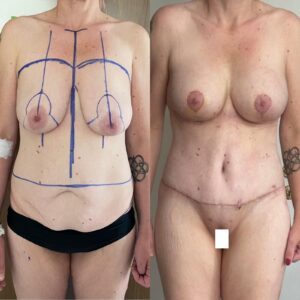 Mommy makeover turkey before and after tummy tuck results EsteVia Clinic antalya